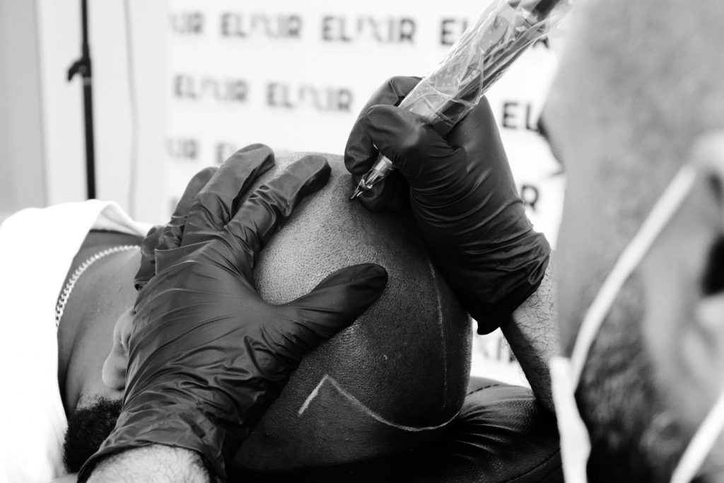Scalp Micropigmentation