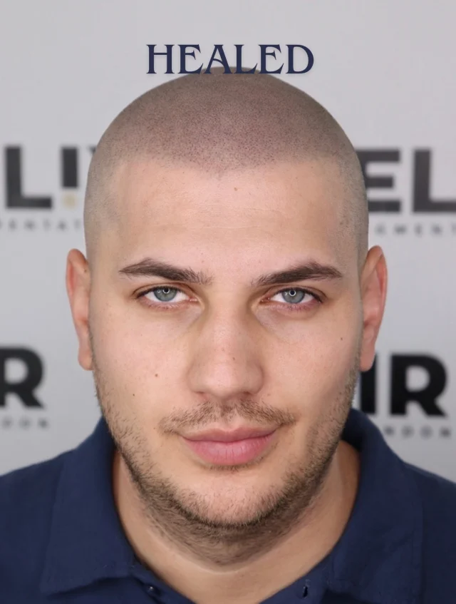 Why so natural? Because SMP should never look overdone.

A strategic touch-up is designed to refresh and refine not oversaturate the scalp. The key is keeping the treatment soft, realistic, and age-proof for years to come.

Less is more when it comes to elite Scalp Micropigmentation.

#hairtattoo #smp #scalpmicropigmentation #scalpmicropigmentationtraining
